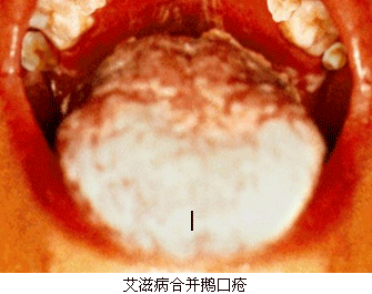 口疮