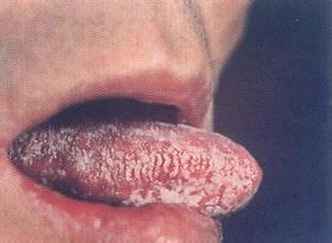 艾滋病症状舌毛状白斑